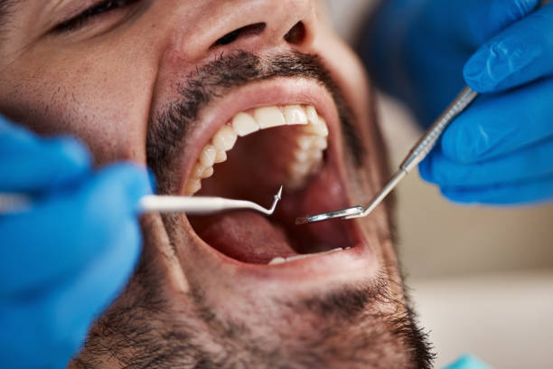 Best Root Canal Emergency Dentist  in Manson, IA